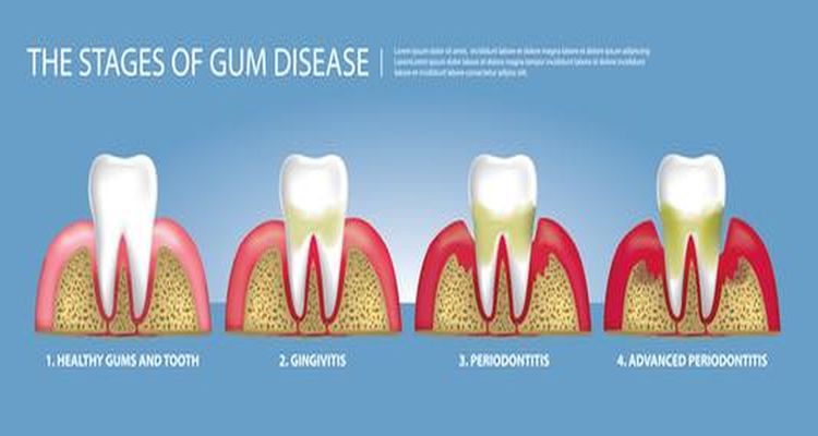 Healthy Gum Tips Hygienist